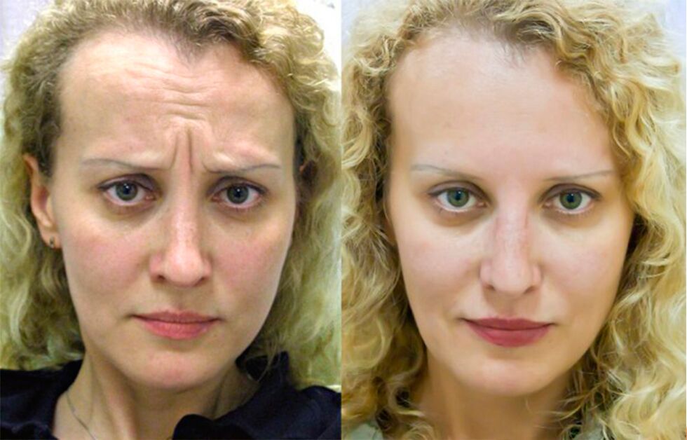 enne ja pärast masseerija kasutamist noorendamiseks ltza foto 1