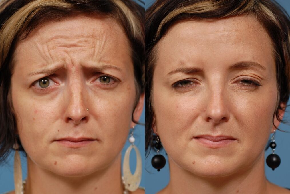 enne ja pärast masseerija kasutamist noorendamiseks ltza foto 2