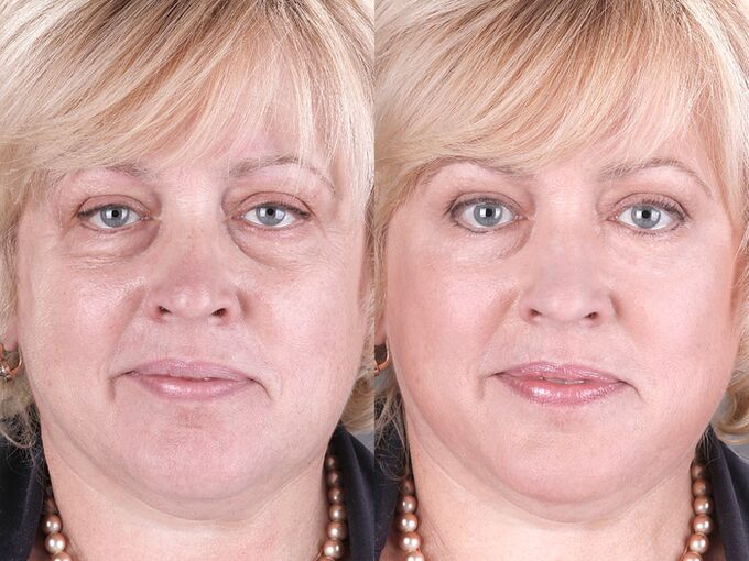 enne ja pärast masseerija kasutamist noorendamiseks ltza foto 3