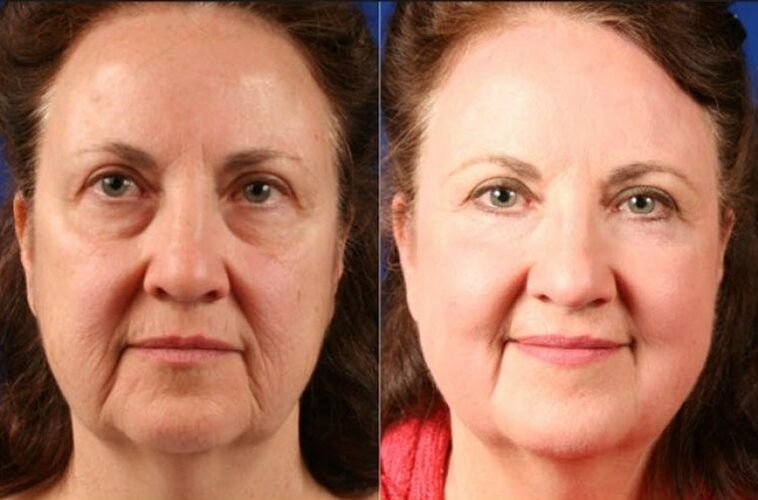 enne ja pärast masseerija kasutamist noorendamiseks ltza foto 6
