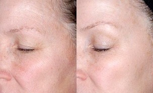 silmaümbruse naha noorendamine enne ja pärast fotosid
