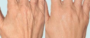 Käte nahk enne ja pärast fraktsioneerivat ravi