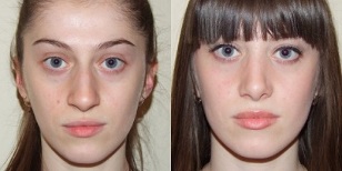 enne ja pärast naha plasma noorendamist